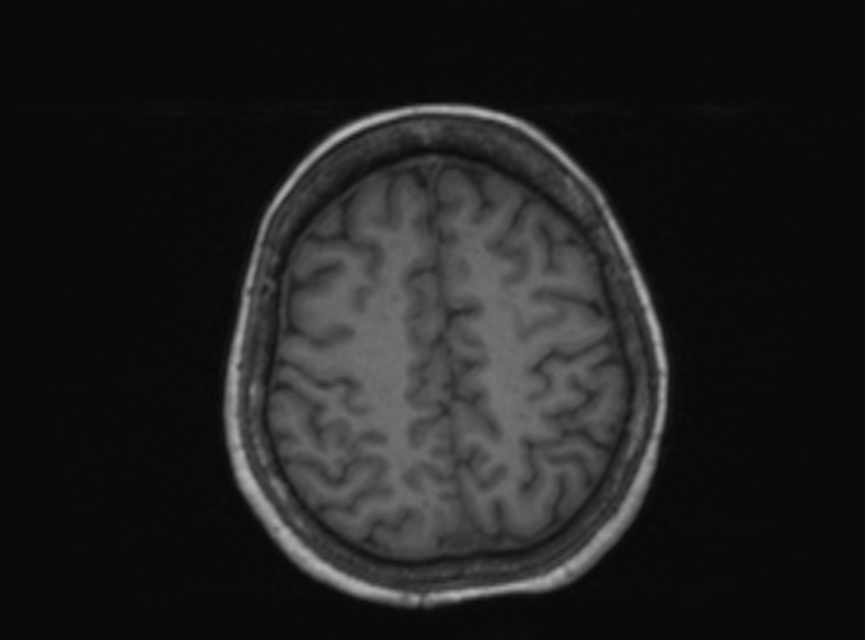 Bilateral PCA territory infarction - different ages (Radiopaedia 46200-51784 Axial T1 168).jpg