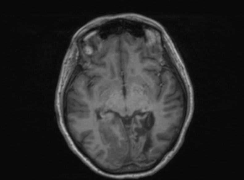 File:Bilateral PCA territory infarction - different ages (Radiopaedia 46200-51784 Axial T1 252).jpg