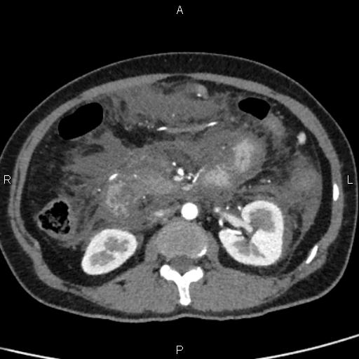 Bilateral adrenal gland hyperenhancement in pancreatitis (Radiopaedia 86642-102753 B 62).jpg
