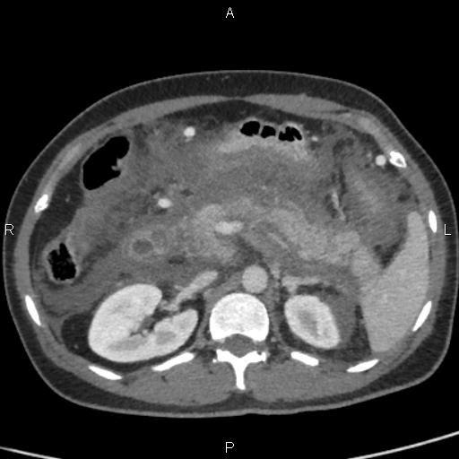 Bilateral adrenal gland hyperenhancement in pancreatitis (Radiopaedia 86642-102753 E 37).jpg