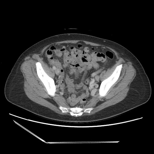 Bilateral adrenal granulocytic sarcomas (chloromas) (Radiopaedia 78375-91007 A 96).jpg
