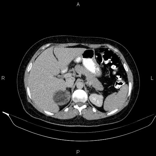 Bilateral adrenal myelolipoma (Radiopaedia 63058-71535 Axial C+ delayed 22).jpg