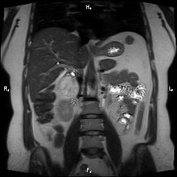 File:Bilateral adrenal myelolipoma (Radiopaedia 63058-71537 Coronal T2 16).jpg