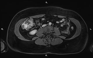 Bilateral adrenal myelolipoma (Radiopaedia 63058-71537 G 66).jpg