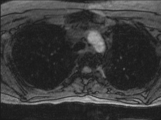 Bilateral carotid body tumors and right glomus jugulare tumor (Radiopaedia 20024-20060 Axial MRA 154).jpg
