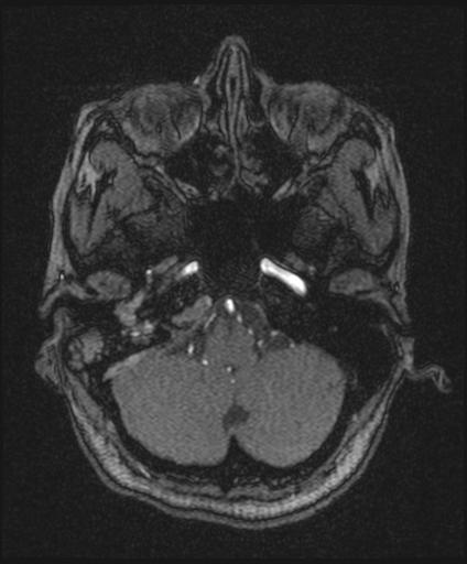 Bilateral carotid body tumors and right glomus jugulare tumor (Radiopaedia 20024-20060 Axial MRA 35).jpg