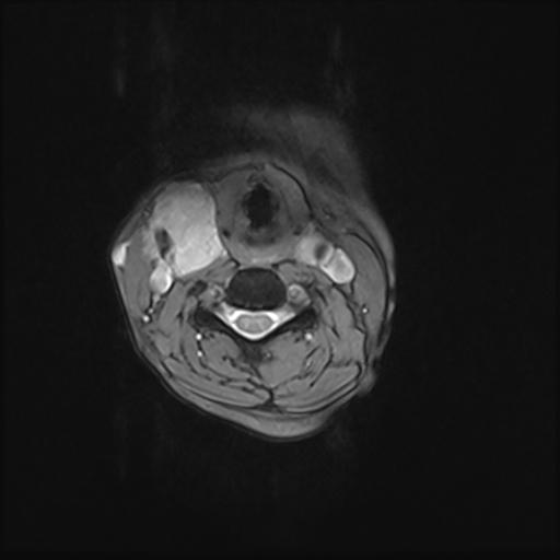 File:Bilateral carotid body tumors and right jugular paraganglioma (Radiopaedia 20024-20060 Axial 80).jpg