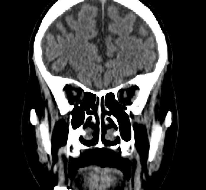 Bilateral ectopia lentis (Radiopaedia 89889-107013 Coronal non-contrast 83).jpg