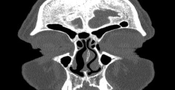 File:Bilateral ectopic infraorbital nerves (Radiopaedia 49006-54084 Coronal 64).png
