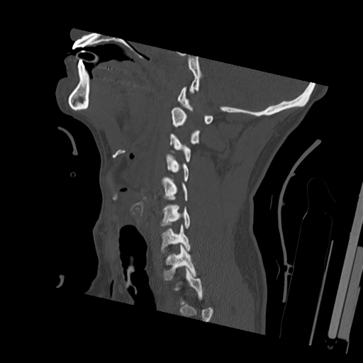 Bilateral locked facets (Radiopaedia 33850-35023 Sagittal bone window 39).png