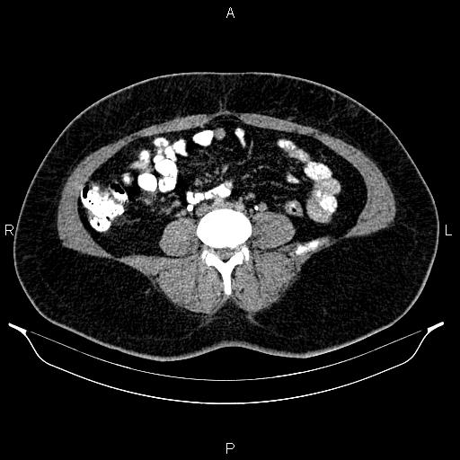 Bilateral ovarian dermoid cysts (Radiopaedia 85785-101603 Axial C+ delayed 46).jpg