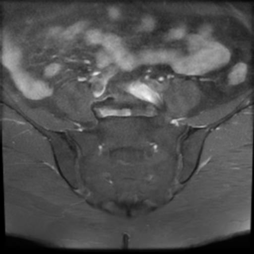 File:Bilateral ovarian dermoid cysts (Radiopaedia 90152-107338 Axial T1 C+ fat sat 3).jpg