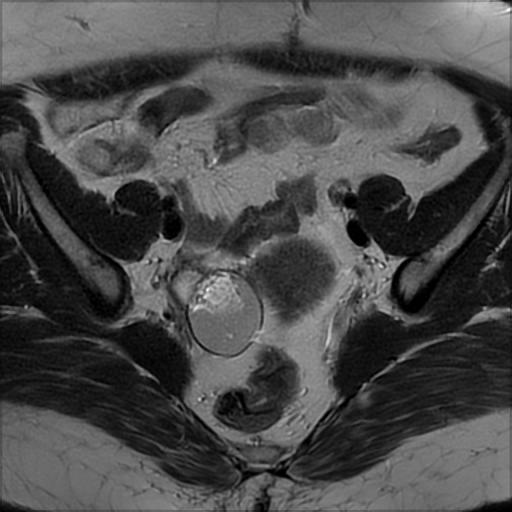 File:Bilateral ovarian dermoid cysts (Radiopaedia 90152-107338 Axial T2 9).jpg