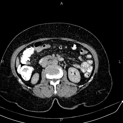 Bilateral ovarian serous cystadenocarcinoma (Radiopaedia 86062-101989 Axial C+ delayed 28).jpg