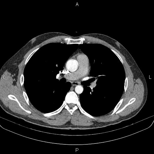 Bilateral pulmonary AVM (Radiopaedia 83134-97505 A 34).jpg