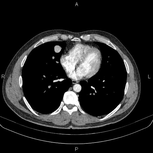 Bilateral pulmonary AVM (Radiopaedia 83134-97505 A 47).jpg