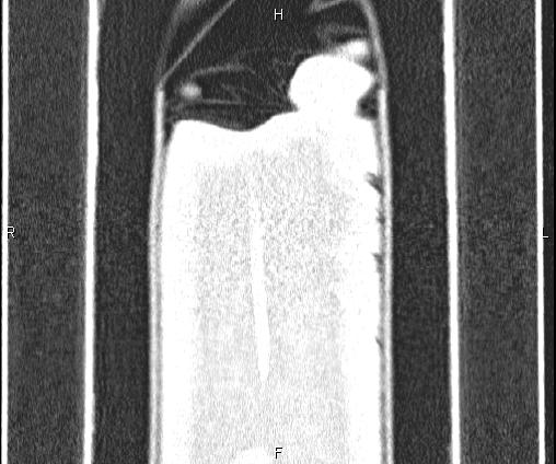 Bilateral pulmonary AVM (Radiopaedia 83134-97505 Coronal lung window 85).jpg