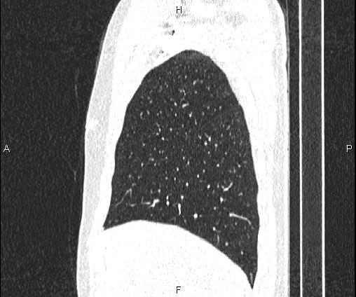File:Bilateral pulmonary AVM (Radiopaedia 83134-97505 Sagittal lung window 29).jpg