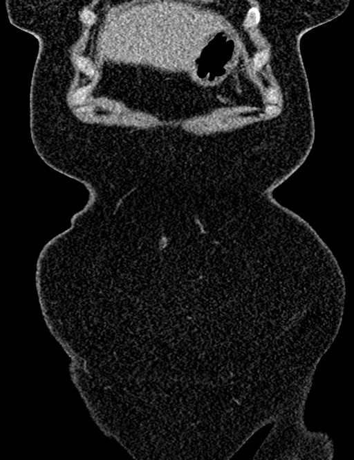Bilateral staghorn calculi (Radiopaedia 59475-66842 Coronal non-contrast 34).jpg