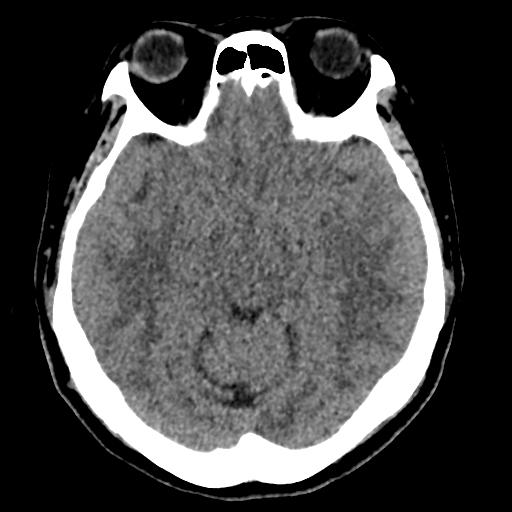 Bilateral subacute subdural hematoma (Radiopaedia 69240-79018 Axial non-contrast 19).jpg