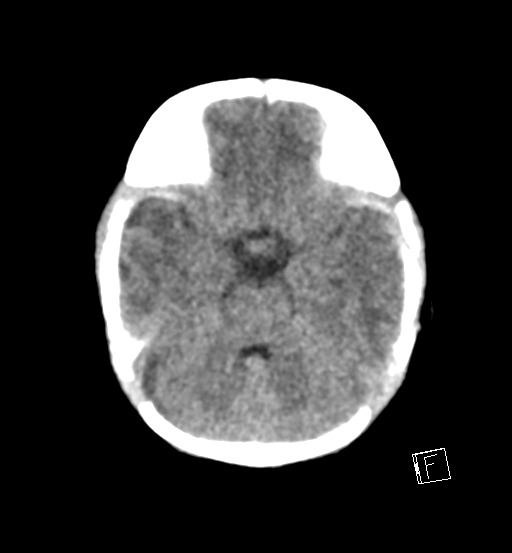 File:Bilateral subdural hemorrhage and parietal skull fracture (Radiopaedia 26058-26192 Axial non-contrast 18).png