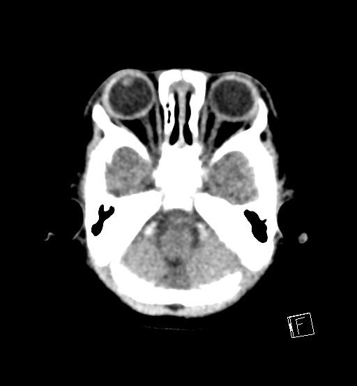 File:Bilateral subdural hemorrhage and parietal skull fracture (Radiopaedia 26058-26192 Axial non-contrast 21).png
