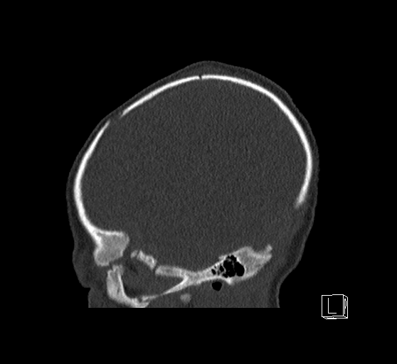 File:Bilateral subdural hemorrhage and parietal skull fracture (Radiopaedia 26058-26192 Sagittal bone window 81).png