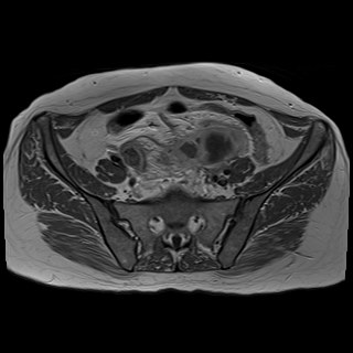 Bilateral tubo-ovarian abscesses (Radiopaedia 58635-65829 Axial T1 C+ 13).jpg
