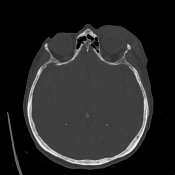 Biparietal osteodystrophy (Radiopaedia 46109-50463 bone window 32).jpg