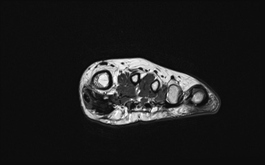 Bipartite hallux sesamoid diastasis (Radiopaedia 77133-89109 Coronal PD 24).jpg