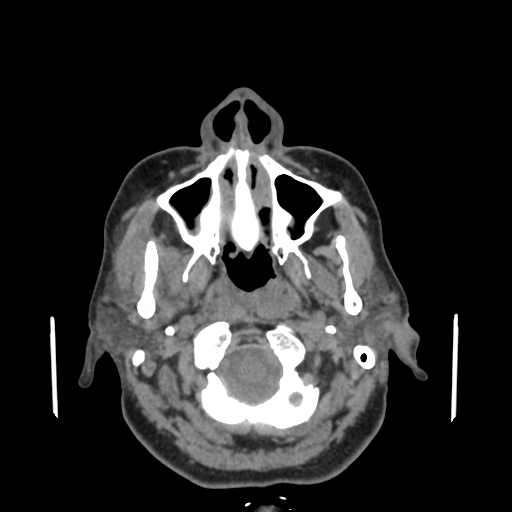 Bisphosphonate-related osteonecrosis of the jaw (Radiopaedia 71324-81642 non-contrast 125).jpg
