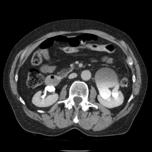 Bladder tumor detected on trauma CT (Radiopaedia 51809-57609 C 58).jpg