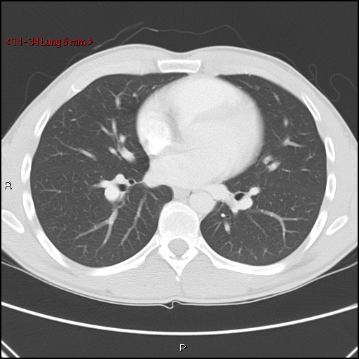 File:Blunt chest trauma - pulmonary interstitial emphysema and pneumomediastinum (Radiopaedia 20666-20552 Axial lung window 34).jpg