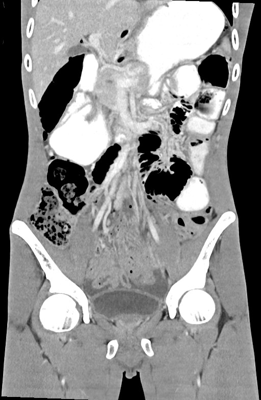 Blunt injury to the small bowel (Radiopaedia 74953-85987 B 42).jpg