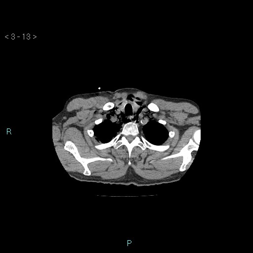 Boerhaave syndrome (Radiopaedia 27683-27897 Axial non-contrast 13).jpg