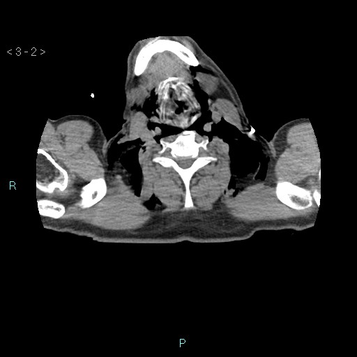 Boerhaave syndrome (Radiopaedia 27683-27897 oral contrast 2).jpg