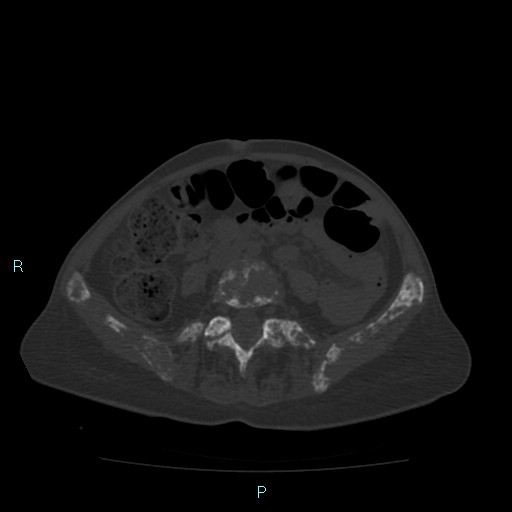 File:Bone metastases from untreated breast cancer (Radiopaedia 42973-46219 Axial bone window 138).jpg