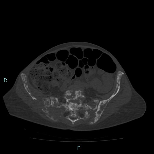 File:Bone metastases from untreated breast cancer (Radiopaedia 42973-46219 Axial bone window 150).jpg