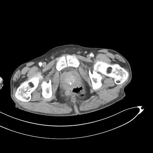 Bone metastasis from squamous cell carcinoma (Radiopaedia 30133-30730 B 79).jpg