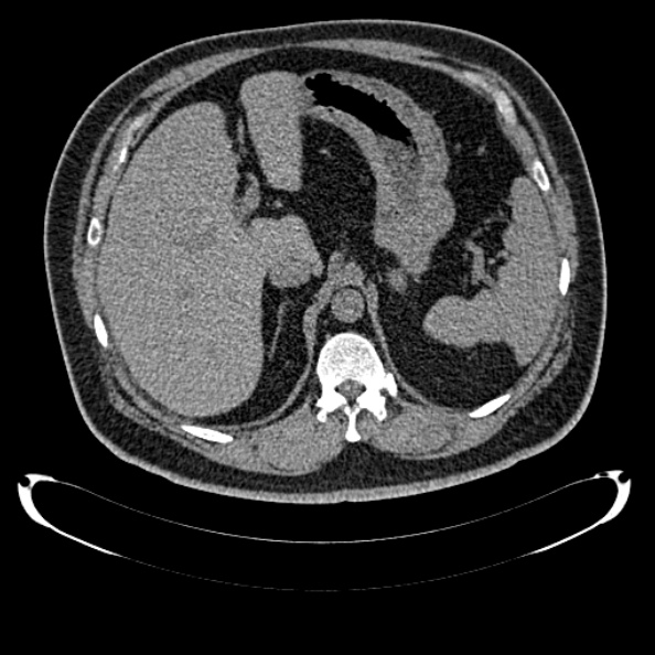 Bosniak renal cyst - type IV (Radiopaedia 24244-24518 Axial non-contrast 103).jpg