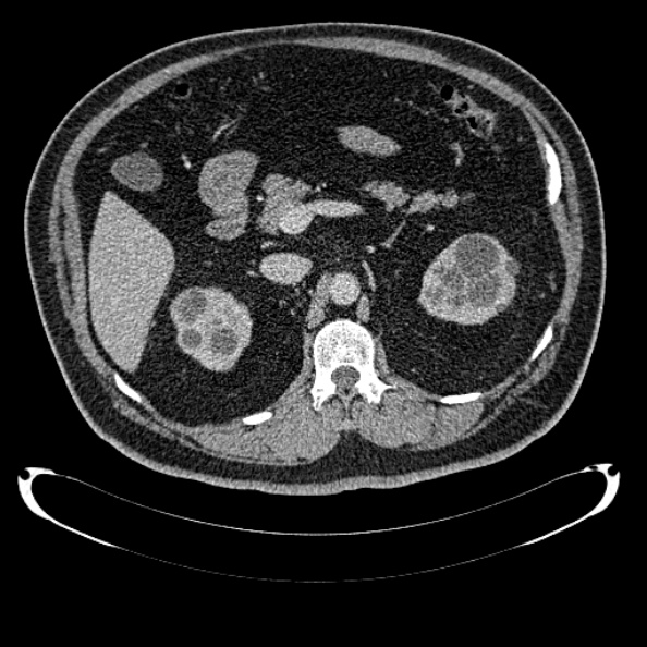 File:Bosniak renal cyst - type IV (Radiopaedia 24244-24518 C 114).jpg