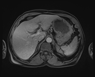 Bouveret syndrome (Radiopaedia 61017-68856 Axial T1 C+ fat sat 22).jpg