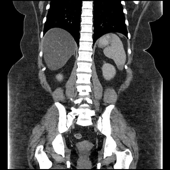 Bowel and splenic infarcts in acute lymphocytic leukemia (Radiopaedia 61055-68913 B 42).jpg