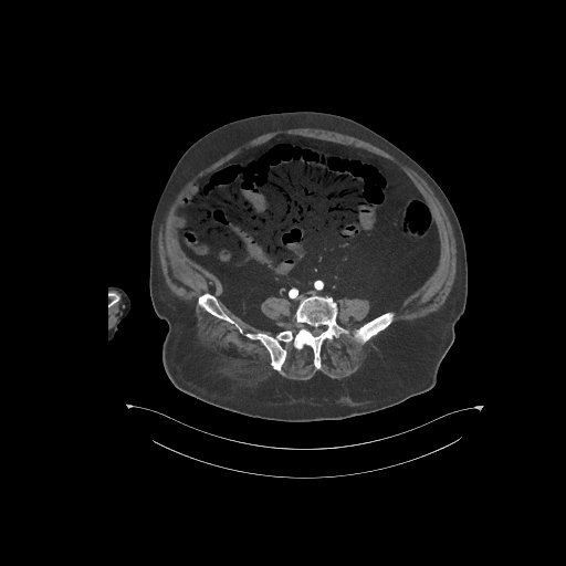 File:Bowel ischemia secondary to SMA occlusion with extensive portomesenteric venous gas (Radiopaedia 54656-60871 A 21).jpg