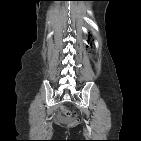 Bowel perforation at ERCP (Radiopaedia 59094-66394 A 48).jpg