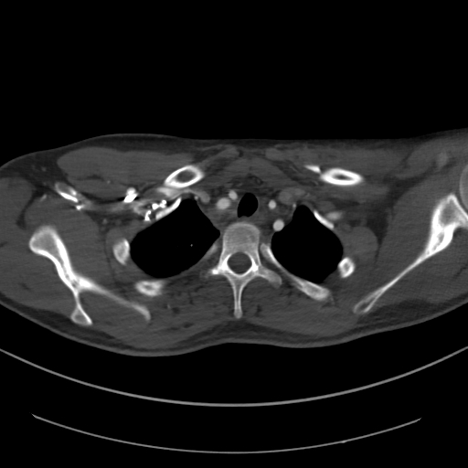 Brachiocephalic trunk pseudoaneurysm (Radiopaedia 70978-81191 Axial bone window 50).jpg