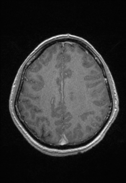 Brain abscess with ventriculitis (Radiopaedia 85703-101495 Axial T1 C+ 126).jpg