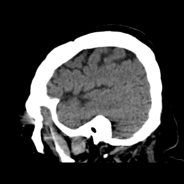 Brain cortical laminar necrosis (Radiopaedia 25822-25971 non-contrast 12).jpg