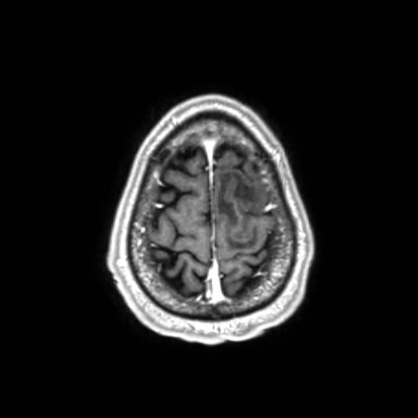 Brain metastases from lung cancer (Radiopaedia 83839-99028 Axial T1 C+ 62).jpg