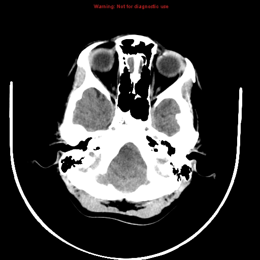 File:Brainstem glioma (Radiopaedia 9444-10123 non-contrast 2).jpg